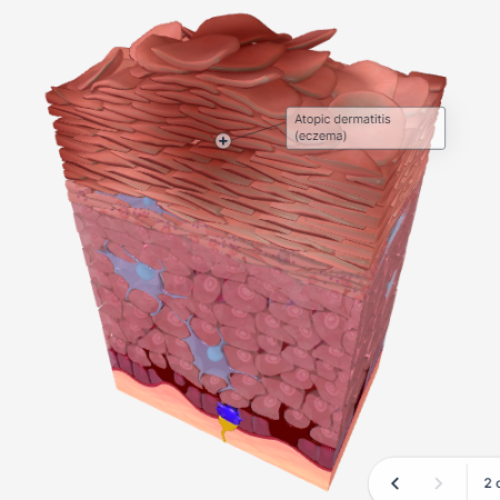 BioDigital 3D Animations on AccessDermatologyDxRx - Eczema
